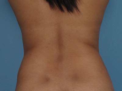 Tummy Tuck Before & After Image