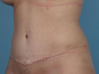 Tummy Tuck Before & After Image