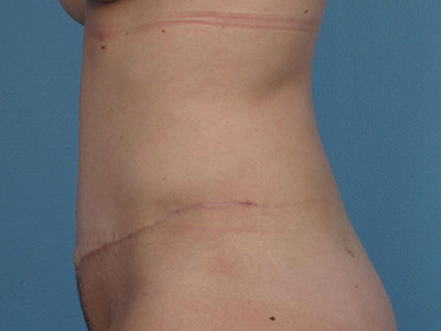 Tummy Tuck Before & After Image