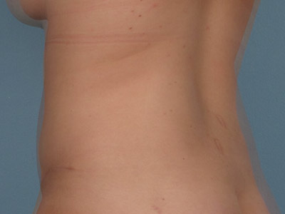 Tummy Tuck Before & After Image