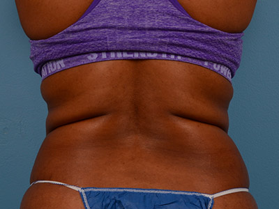 Tummy Tuck Before & After Image