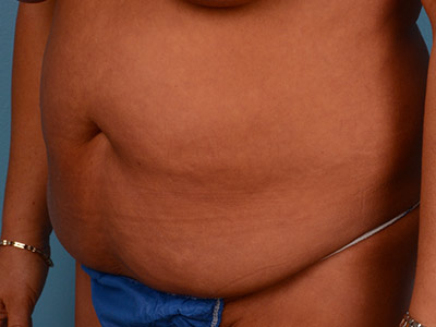 Tummy Tuck Before & After Image