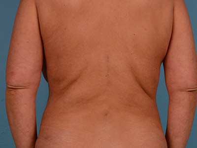 Tummy Tuck Before & After Image