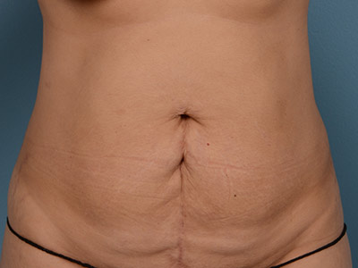 Tummy Tuck Before & After Image