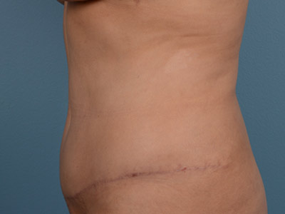 Tummy Tuck Before & After Image