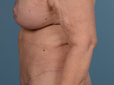 Tummy Tuck Before & After Image