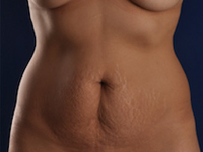 Tummy Tuck Before & After Image