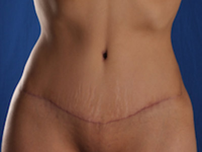 Tummy Tuck Before & After Image