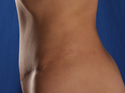 Tummy Tuck Before & After Image