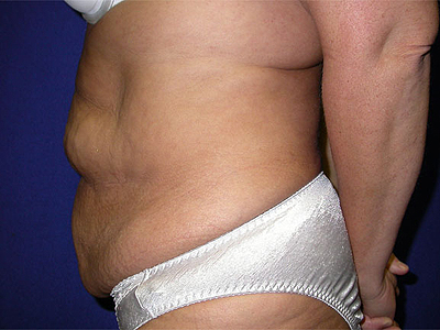 Tummy Tuck Before & After Image