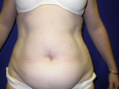 Tummy Tuck Before & After Image