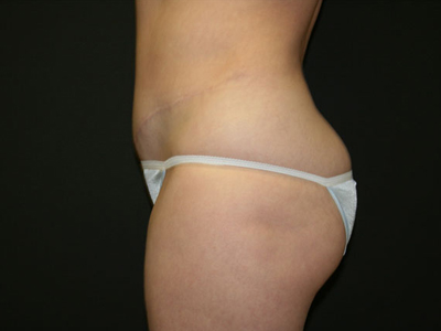 Tummy Tuck Before & After Image