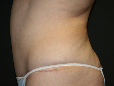 Tummy Tuck Before & After Image