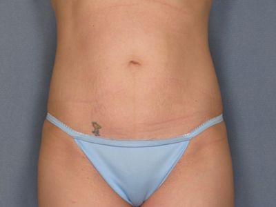 Tummy Tuck Before & After Image