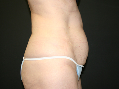 Tummy Tuck Before & After Image