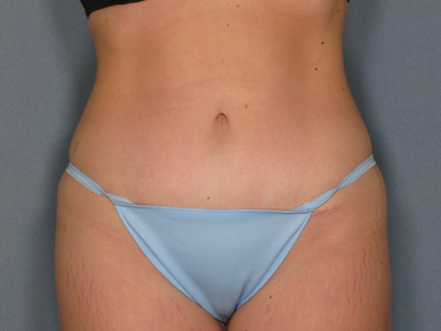 Tummy Tuck Before & After Image