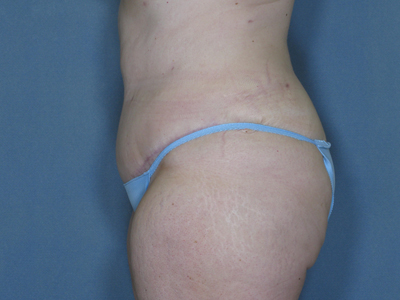 Tummy Tuck Before & After Image