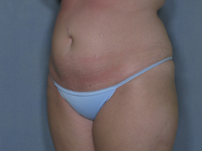 Tummy Tuck Before & After Image