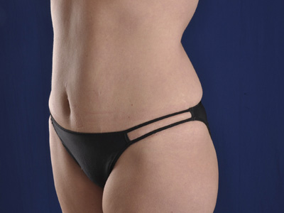 Tummy Tuck Before & After Image