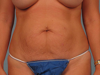 Tummy Tuck Before & After Image