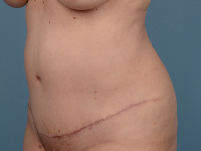 Tummy Tuck Before & After Image