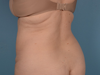 Tummy Tuck Before & After Image