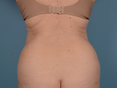 Tummy Tuck Before & After Image