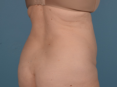 Tummy Tuck Before & After Image