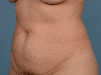 Tummy Tuck Before & After Image