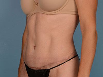 Tummy Tuck Before & After Image