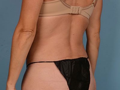 Tummy Tuck Before & After Image