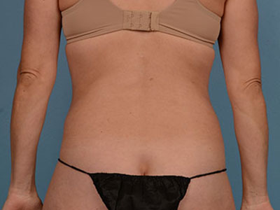 Tummy Tuck Before & After Image