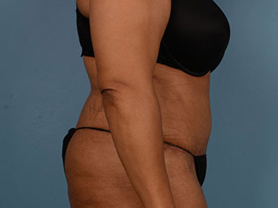 Tummy Tuck Before & After Image