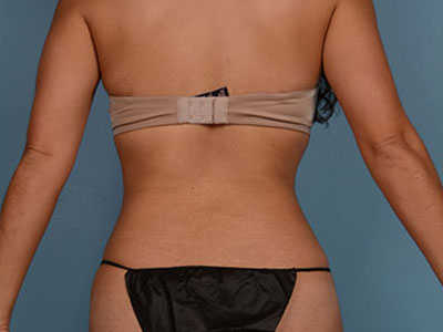 Tummy Tuck Before & After Image