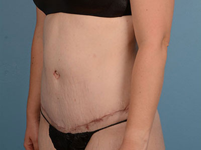 Tummy Tuck Before & After Image