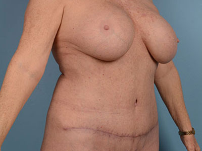 Tummy Tuck Before & After Image