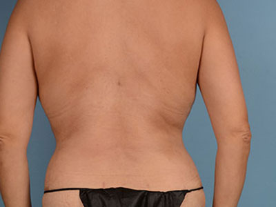 Tummy Tuck Before & After Image