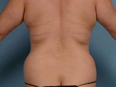 Tummy Tuck Before & After Image