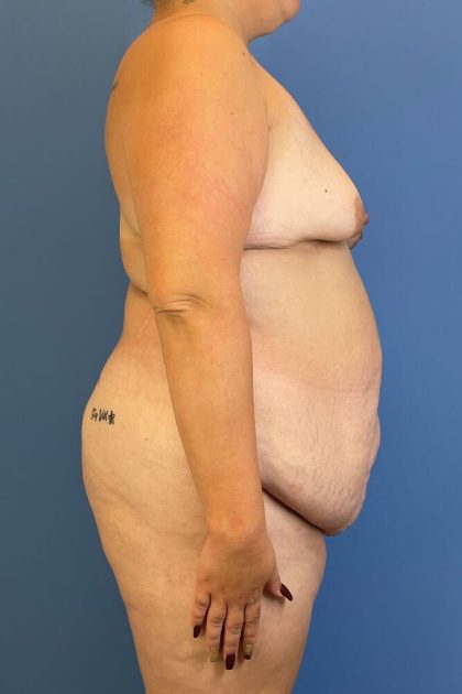 Tummy Tuck Before & After Image