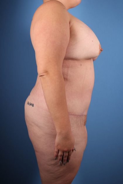 Tummy Tuck Before & After Image