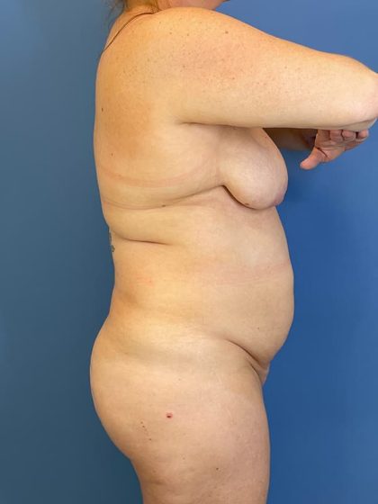 Tummy Tuck Before & After Image