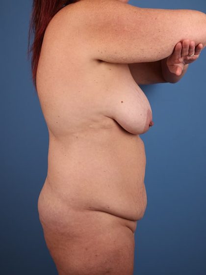 Tummy Tuck Before & After Image