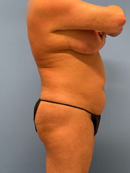 Tummy Tuck Before & After Image