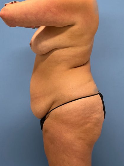 Tummy Tuck Before & After Image