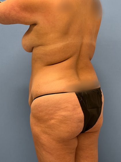 Tummy Tuck Before & After Image