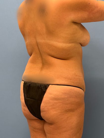 Tummy Tuck Before & After Image