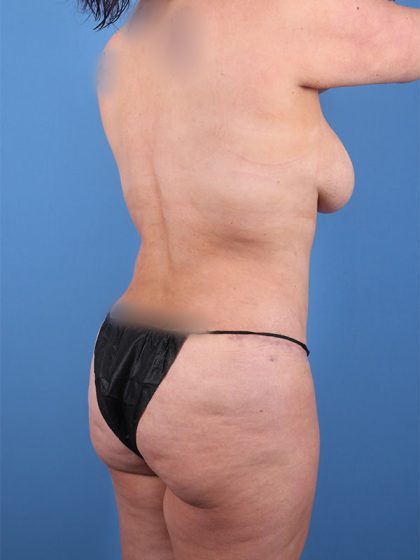 Tummy Tuck Before & After Image