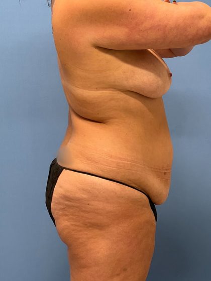 Tummy Tuck Before & After Image