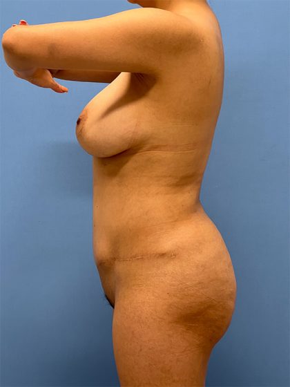 Tummy Tuck Before & After Image