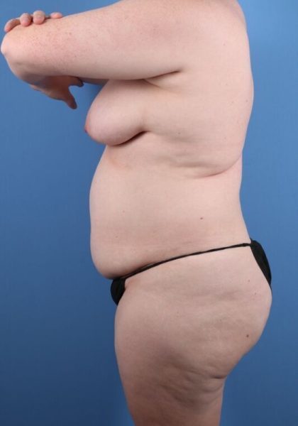 Tummy Tuck Before & After Image